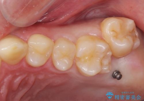 下の歯のがたつきが気になる。 インビザラン&ワイヤー部分矯正併用の治療前