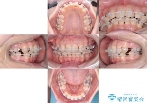 口ボコと歯のデコボコが気になる!|前歯が出ていて口が閉じにくい|審美ワイヤー矯正による口元の改善!の治療中