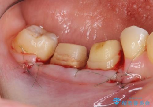 歯周ポケットの除去を併用したセラミック治療の治療中