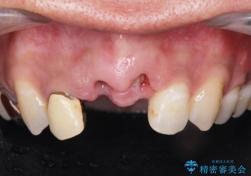 [ 前歯セラミックブリッジ治療 ]  転んで抜けた前歯 、見た目をきれいにしたいの治療中