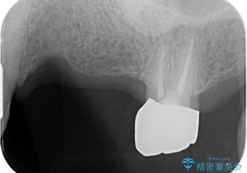 入れ歯では食事を楽しめない。インプラントによる咬合機能回復の治療前