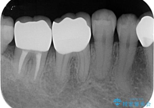 歯周ポケットの除去を併用したセラミック治療の治療後