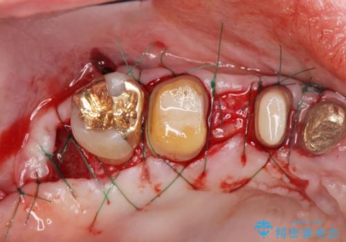 歯周ポケットの除去を併用したセラミック治療の治療中