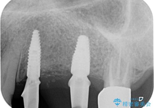 入れ歯では食事を楽しめない。インプラントによる咬合機能回復の治療中