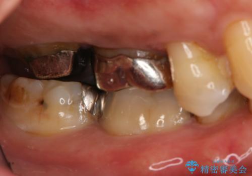 奥歯が取れた フルジルコニアクラウンの治療前