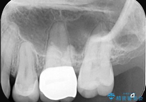歯と歯の間の虫歯もセラミックで再発防止の症例 治療後