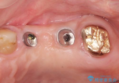 入れ歯では食事を楽しめない。インプラントによる咬合機能回復の治療中