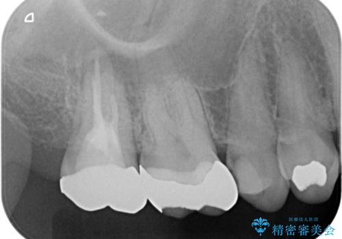 右奥歯治療が必要と言われた。の治療前