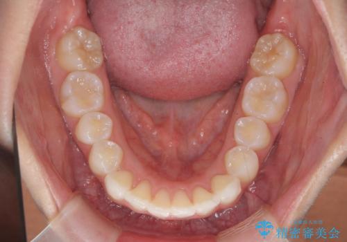 前歯のがたつき気になる。インビザラインモデレートの治療後