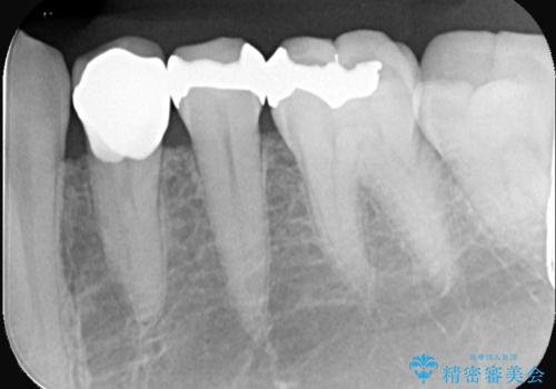 銀歯の下に虫歯 〈オールセラミッククラウン〉の治療後