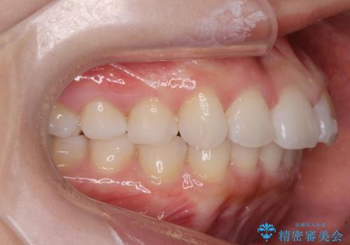 前歯のがたつき気になる。インビザラインモデレートの治療中