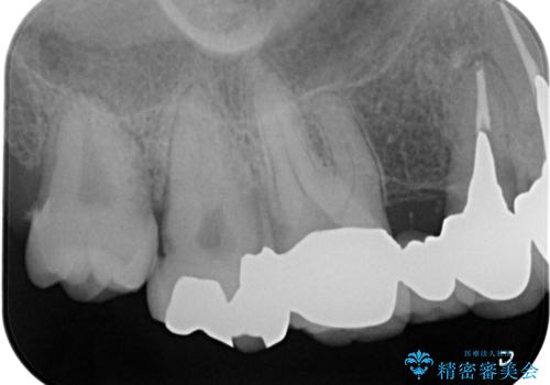 歯周ポケットの除去を併用したセラミック治療の治療前