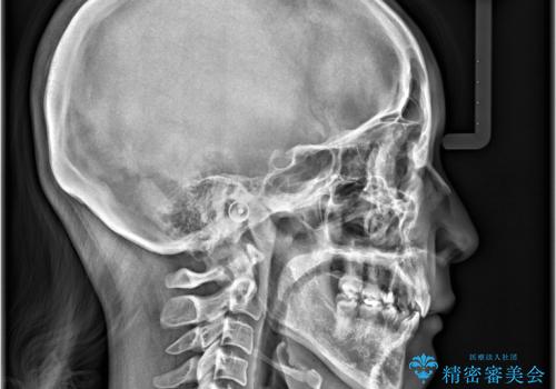 口ボコと歯のデコボコが気になる!|前歯が出ていて口が閉じにくい|審美ワイヤー矯正による口元の改善!の治療後