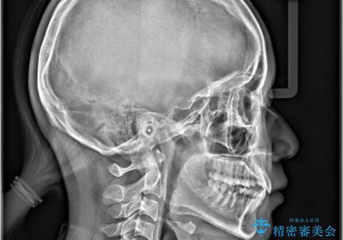 非抜歯矯正で八重歯を改善|短期間8か月で美しい歯並びに|インビザラインライト上顎のみで矯正の治療前