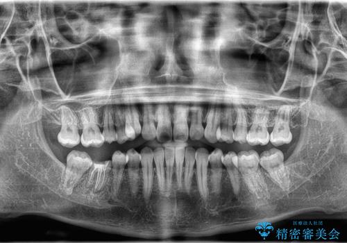 非抜歯矯正で八重歯を改善|短期間8か月で美しい歯並びに|インビザラインライト上顎のみで矯正の治療前