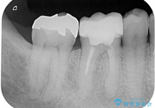 奥歯が痛む オールセラミッククラウンの治療前
