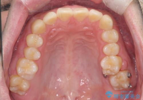 下の歯のがたつきが気になる。 インビザラン&ワイヤー部分矯正併用の治療後