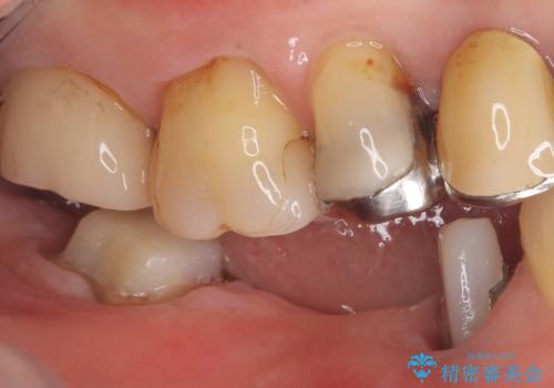 【ゴールドクラウン】セラミックのブリッジが何度も壊れるの治療中