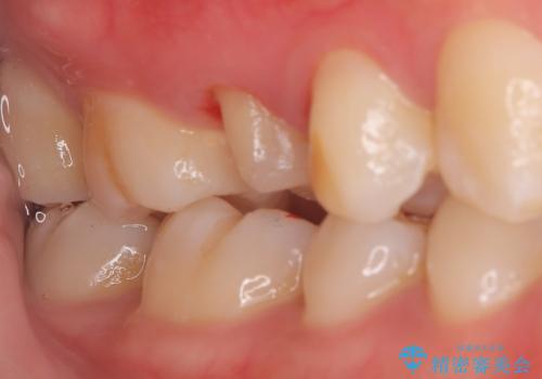 【根管治療】【セラミッククラウン】根っこが細くて治療できないと言われたの治療中