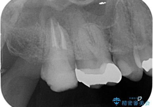 右奥歯治療が必要と言われた。の治療中
