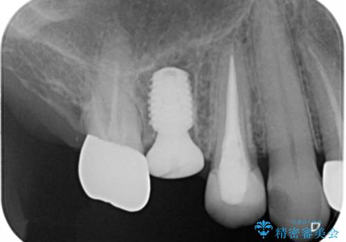 上の奥歯が折れた 抜歯即時埋入インプラントの治療中