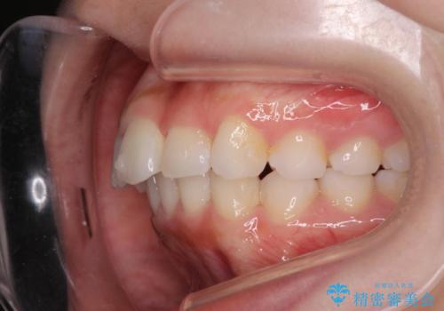 前歯のがたつき気になる。インビザラインモデレートの治療中