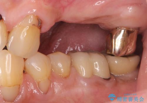 入れ歯では食事を楽しめない。インプラントによる咬合機能回復の治療前