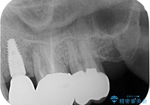 銀歯がとれたのでやり替えたい オールセラミッククラウンの治療後
