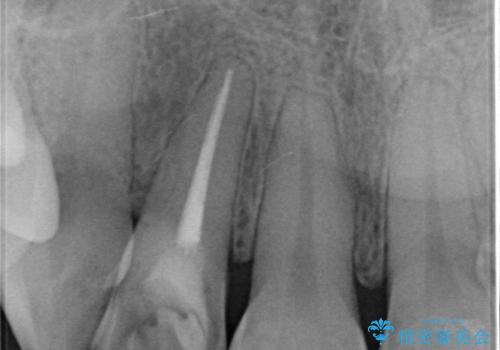 前歯の形と変色が気になる。 ジルコニアクラウンでの修復処置の治療前