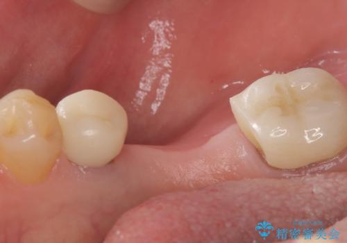 【ゴールドクラウン】セラミックのブリッジが何度も壊れるの治療前
