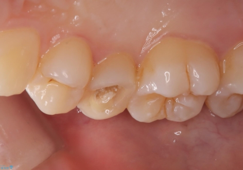 【根管治療】【セラミッククラウン】根っこが細くて治療できないと言われたの治療前