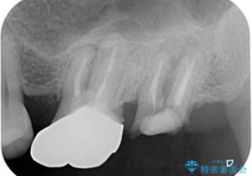 奥歯のむし歯が気になる 根管治療とインプラント治療の治療前
