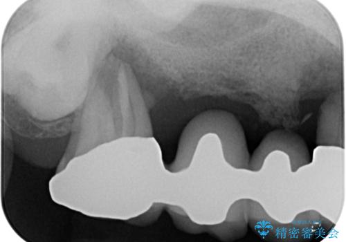 ぐらぐらする奥歯 短期間インプラント治療の治療前