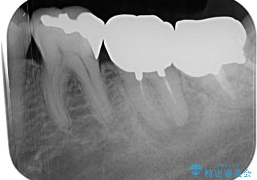 痛すぎて食事がとれない 奥歯の根管治療の治療前