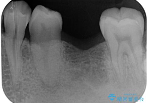 放置した欠損部 奥歯の即時荷重インプラント治療の治療前
