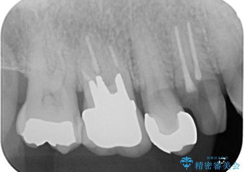 抜歯は避けたい? 1DAYインプラントに魅せられて抜歯即時埋入インプラントによる補綴治療の治療前