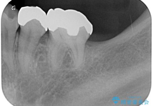 奥歯に歯を入れたい 即時荷重インプラントによる短期間インプラント治療の治療前