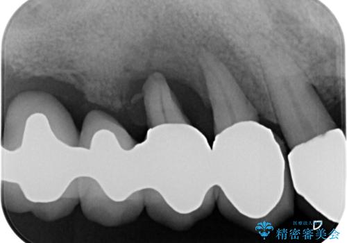 ぐらぐらする奥歯 短期間インプラント治療の治療前