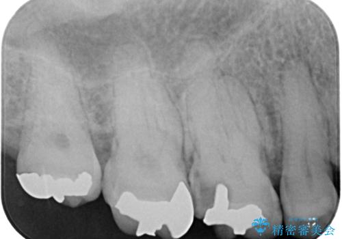 銀歯の下のむし歯 ゴールドクラウンによる補綴治療の治療前