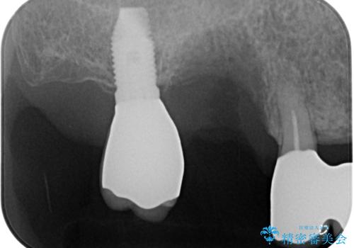 抜けてしまった奥歯 短期間インプラント治療の治療前