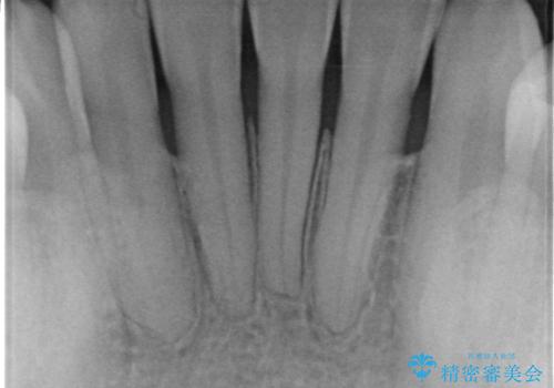 矯正治療で退縮した歯肉 歯肉移植術で露出した歯根を覆い隠すの治療前
