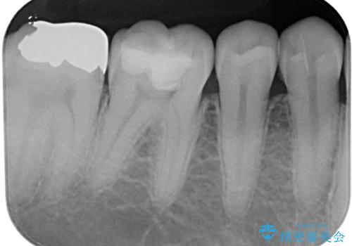 違和感が続く奥歯 慎重な診断を行ったむし歯治療の治療前