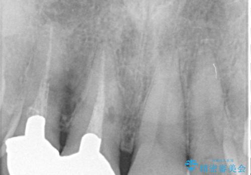 前歯の審美歯科治療 下顎の部分矯正と上顎前歯のオールセラミッククラウンの治療前