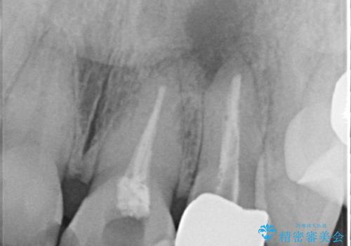 変色してきた歯とプラスチックのクラウン オールセラミッククラウン治療の治療前