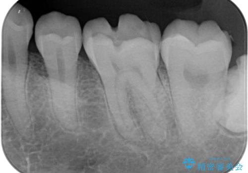 咬合力で破折した奥歯 抜歯即時埋入インプラントによる補綴治療の治療前