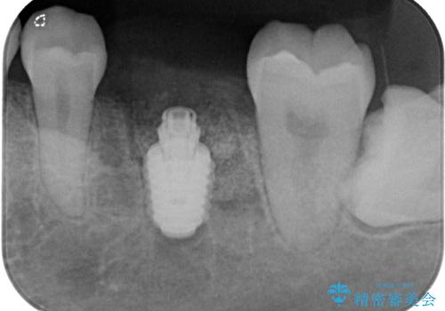 咬合力で破折した奥歯 抜歯即時埋入インプラントによる補綴治療の治療中