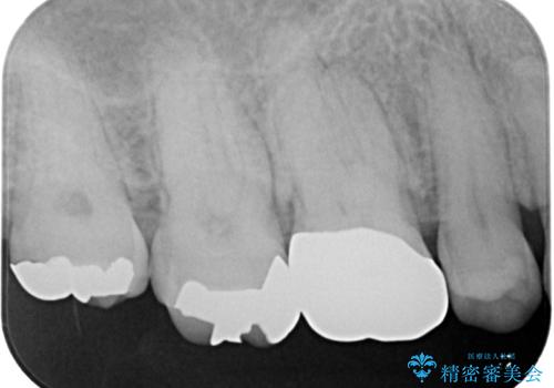 銀歯の下のむし歯 ゴールドクラウンによる補綴治療の治療後