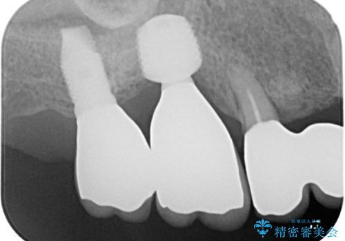 抜けてしまった奥歯 短期間インプラント治療の治療後