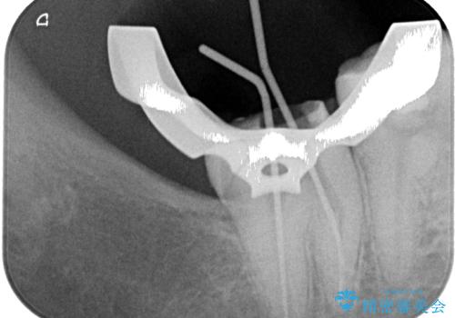 違和感が続く奥歯 慎重な診断を行ったむし歯治療の治療中