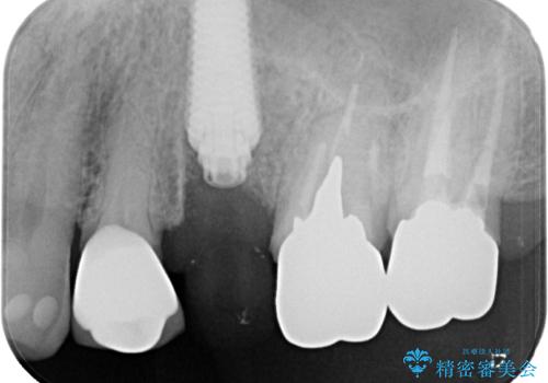 破折した奥歯　抜歯即時埋入インプラントによる補綴治療の治療中